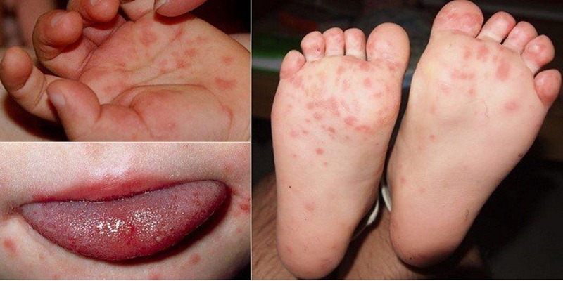Sốt Phát Ban: Chẩn Đoán Chính Xác Và Cách Chữa Trị Hiệu Quả